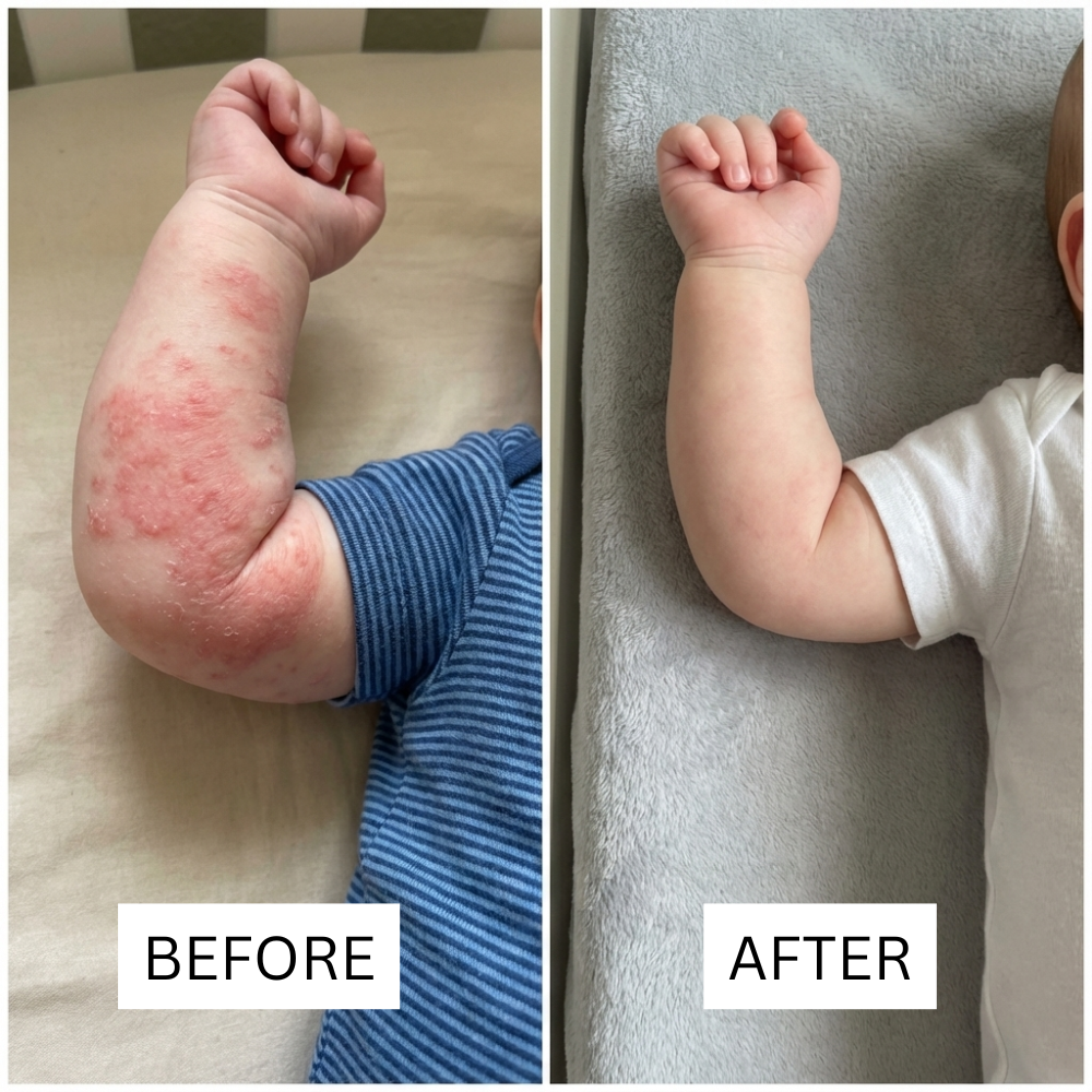 Honey Eczema - Baby Eczema Cream