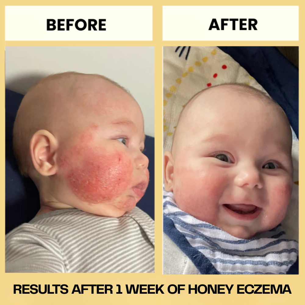 HoneyEczema - Protect Your Baby From Painful Eczema
