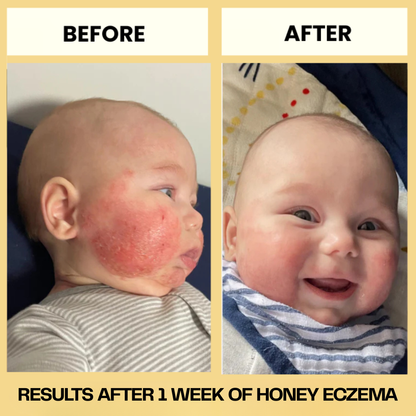 HoneyEczema - Protect Your Baby From Painful Eczema