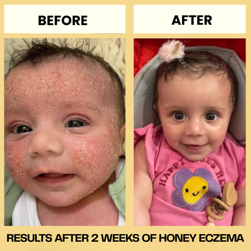 HoneyEczema - Protect Your Baby From Painful Eczema