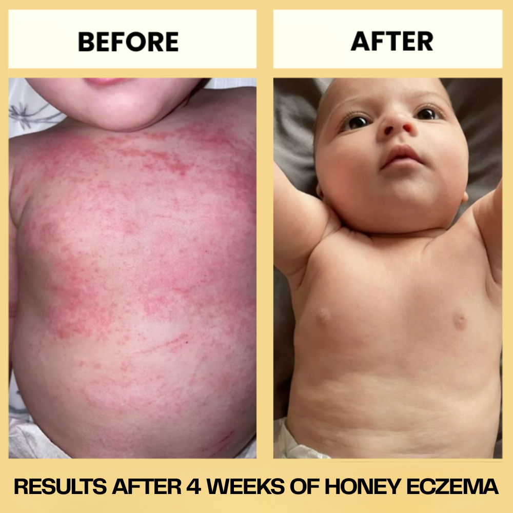 HoneyEczema - Protect Your Baby From Painful Eczema
