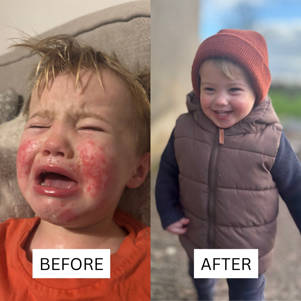 Honey Eczema - Baby Eczema Cream